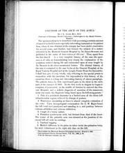 Aneurism of the arch of the aorta